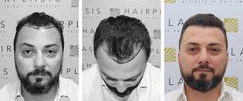 Hair Transplant in Dubai